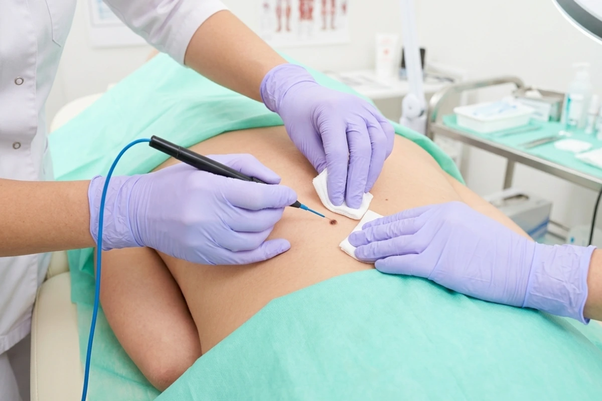 Elektrokauter Bojongsoang Bandung - Klinik Tivaza Light