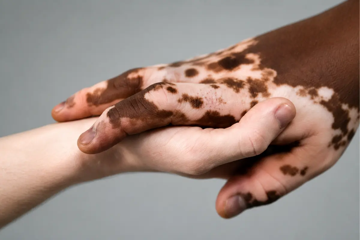Skin Graft Vitiligo Bandung - Klinik Tivaza Bandung