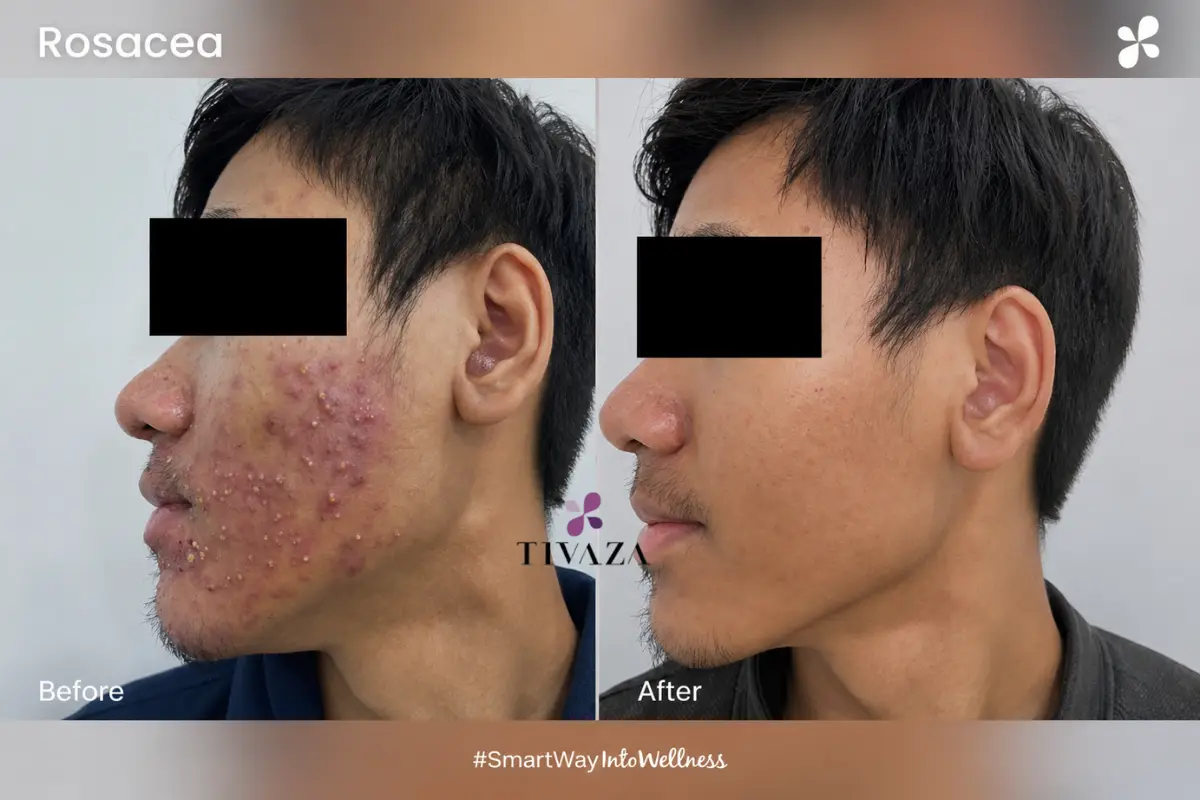 Terapi Rosacea Bojongsoang Bandung - Tivaza Light