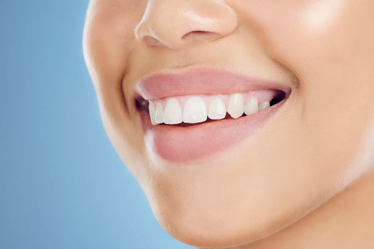Veneer Gigi Estetik Bandung Konsultasi di Tivaza Clinic