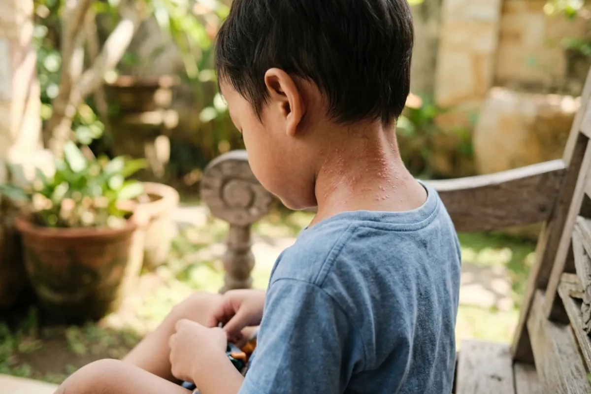 Biang Keringat pada Anak Saat Cuaca Panas Kapan Perlu Diperiksa